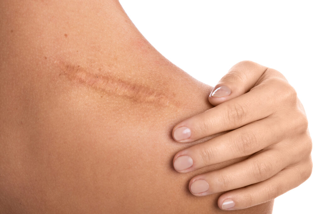 Accident Scar Treatment Clinic in Hyderabad