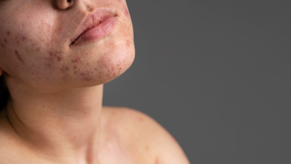 Best Acne Scars Treatment in Hyderabad