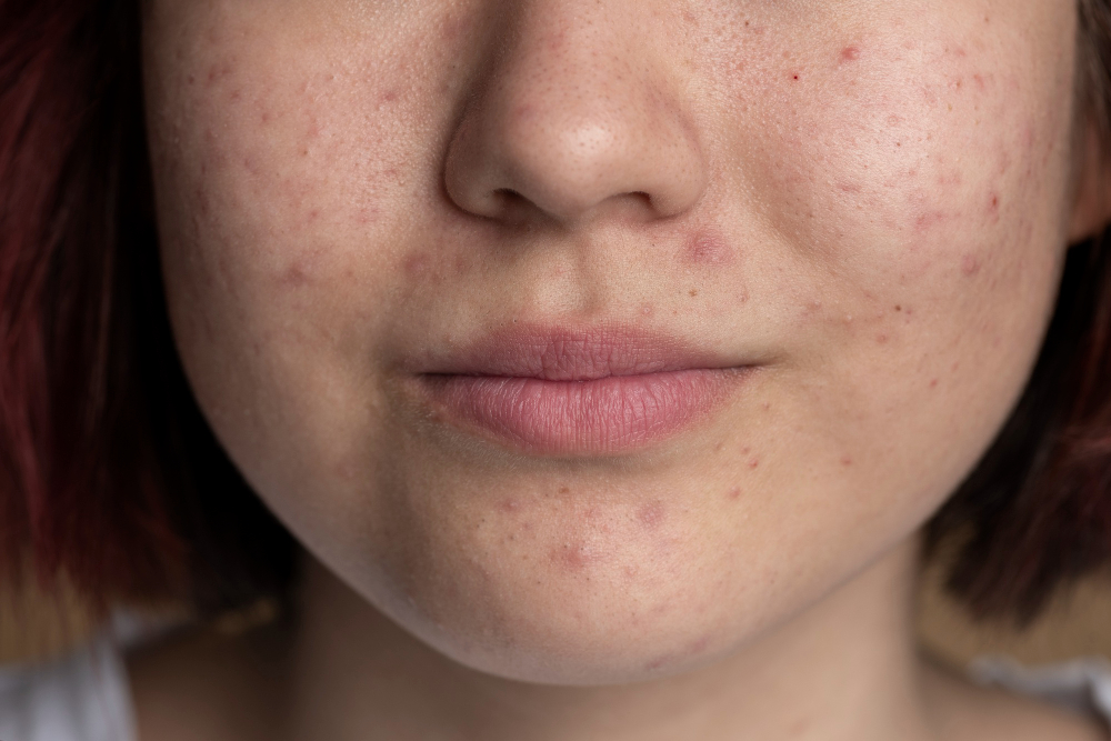 Acne Scars Treatment clinic in Hyderabad