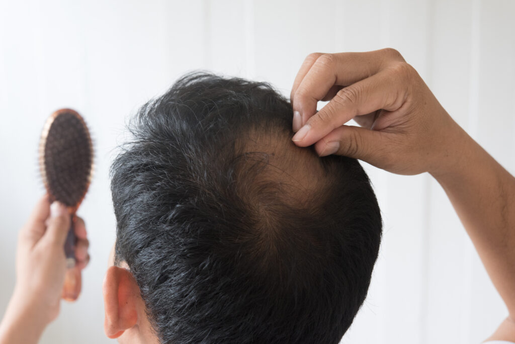 Best Baldness Treatment Clinic in Hyderabad