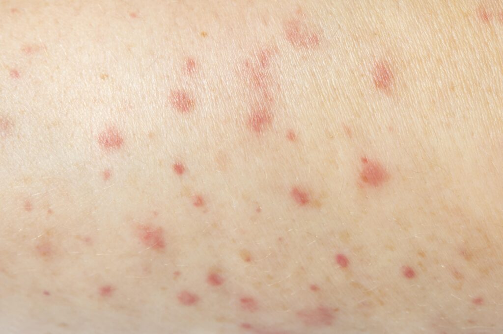 Chickenpox Treatment in Hyderabad