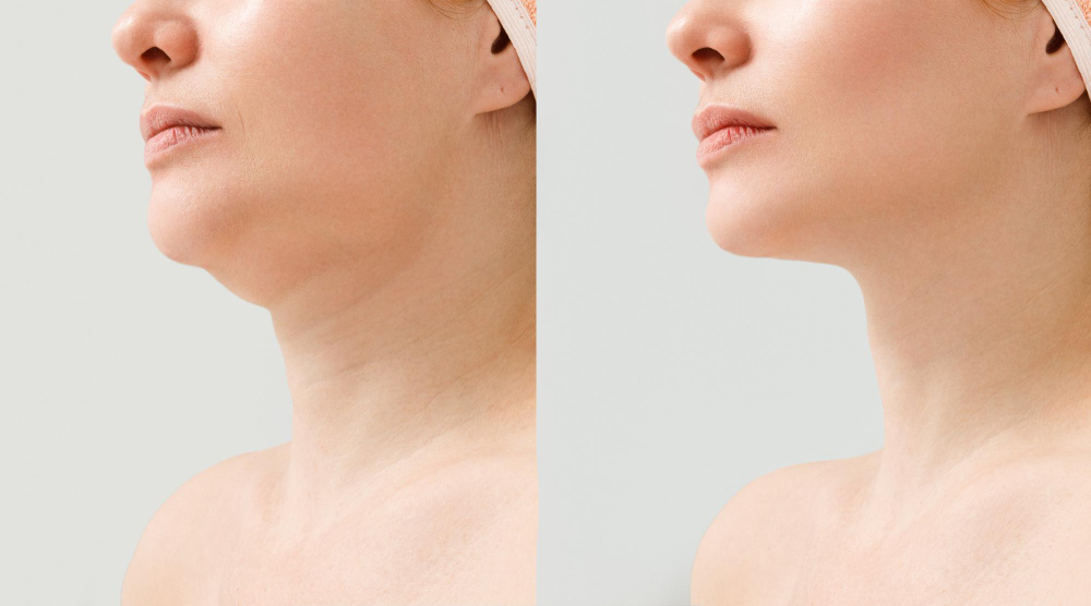 Chin Augmentation Treatment in Hyderabad