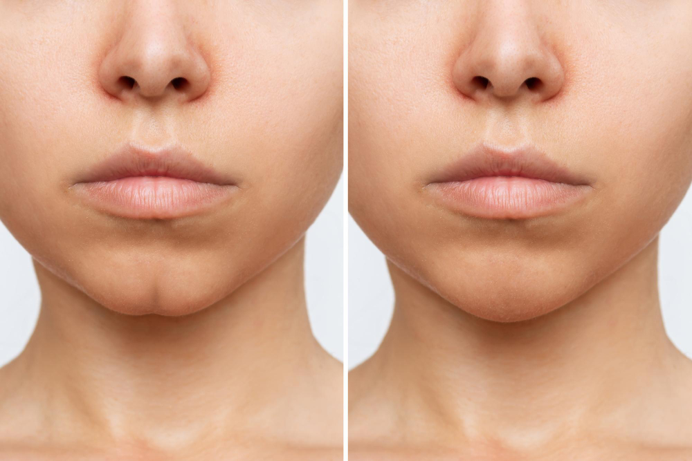 Best Chin Augmentation Treatment in Hyderabad