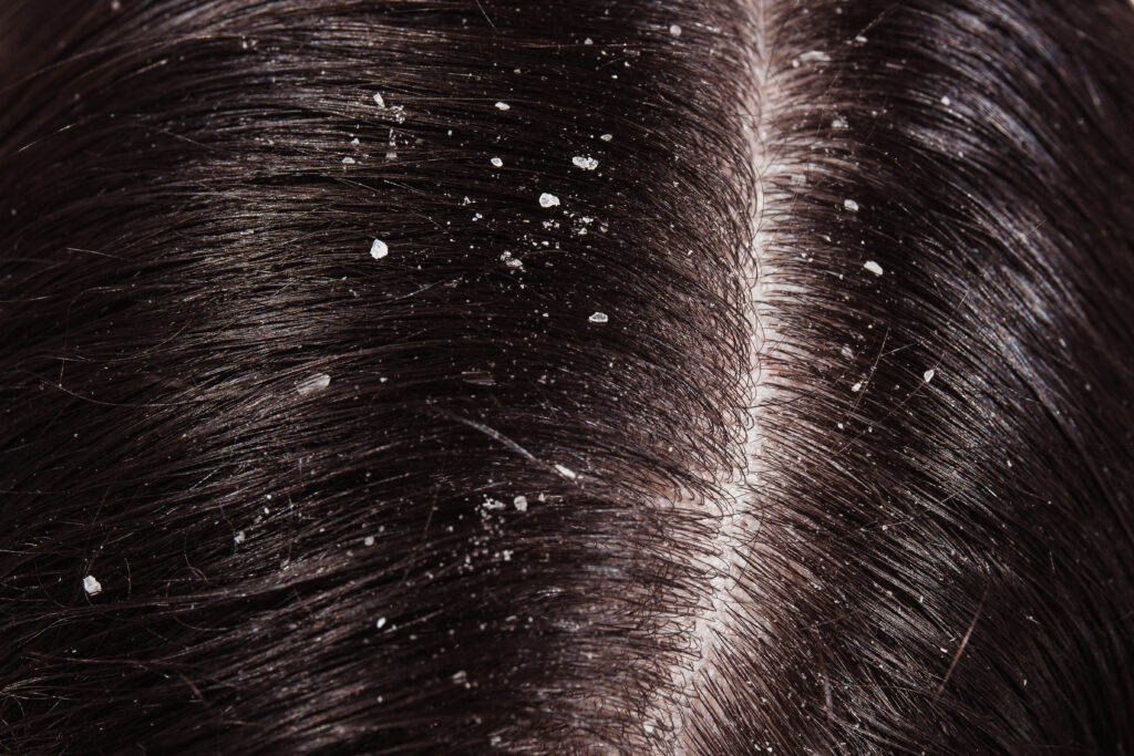 Best Dandruff Treatment in Hyderabad