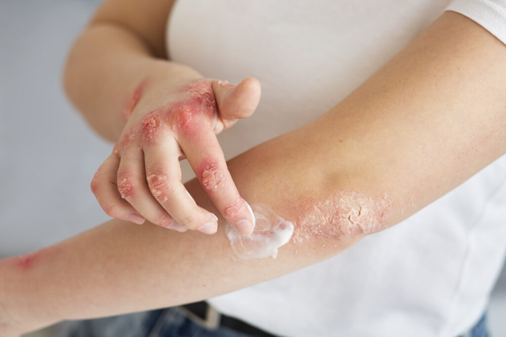 Best Eczema Treatment in Hyderabad