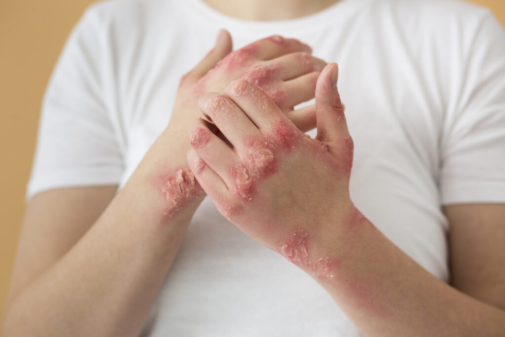 Best Eczema Treatment Clinic in Hyderabad