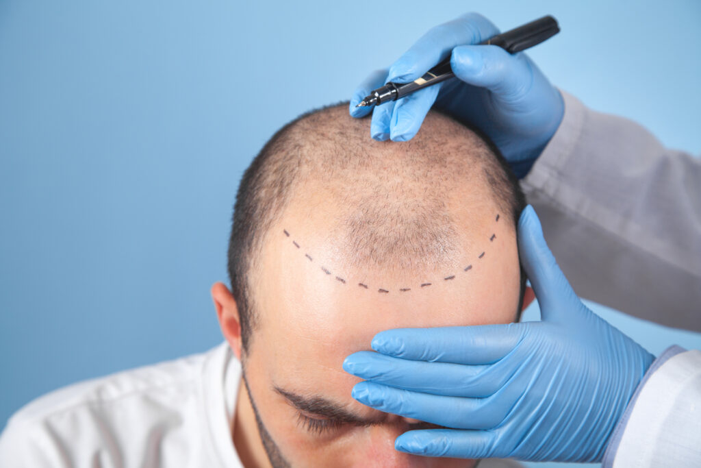 Hair Transplantation Treatment in Hyderabad