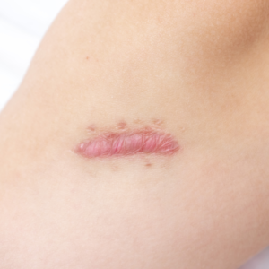 Keloids and Hypertrophic Scars Treatment in Hyderabad