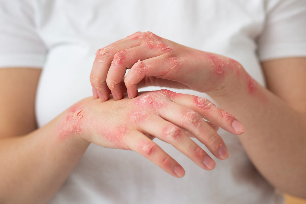 Psoriasis Treatment in Hyderabad