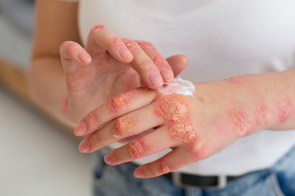 Psoriasis Treatment Clinic in Hyderabad