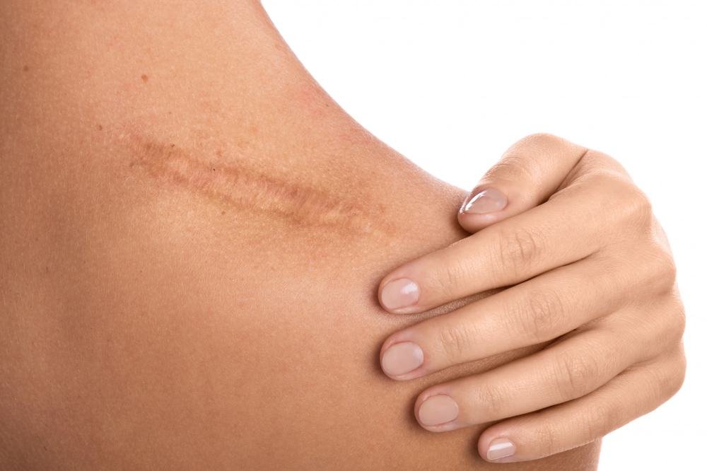 Best Scar Revision Treatment in Hyderabad