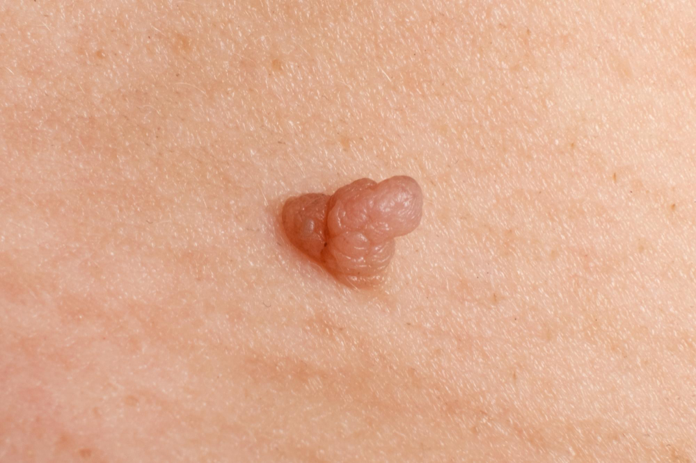 Best Skin Tag and Wart Removal Treatment in Hyderabad