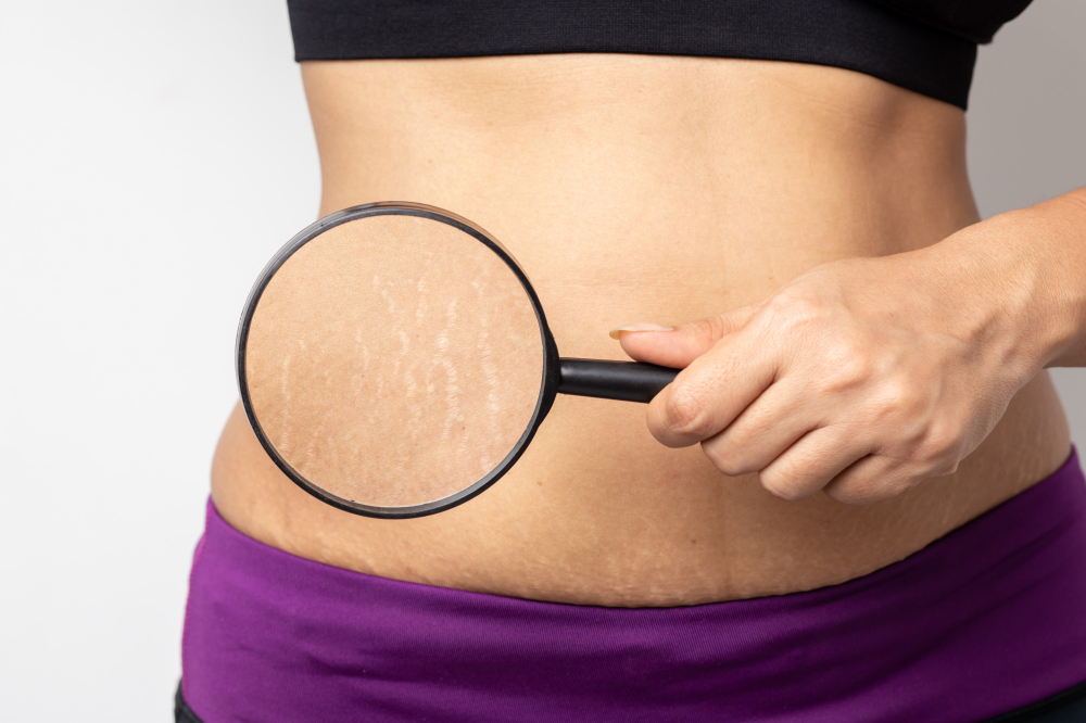 Best Stretch Marks Treatment in Hyderabad