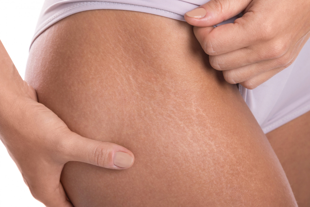 Stretch Marks Treatment in Hyderabad