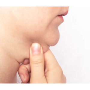 best Double Chin solution Treatment in Hyderabad