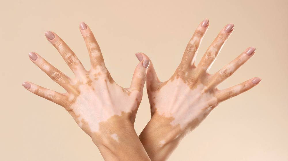 Vitiligo Treatment Clinic in Hyderabad