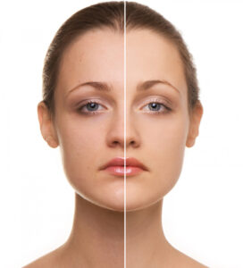 Facial asymmetry correction Treatment clinic in Hyderabad