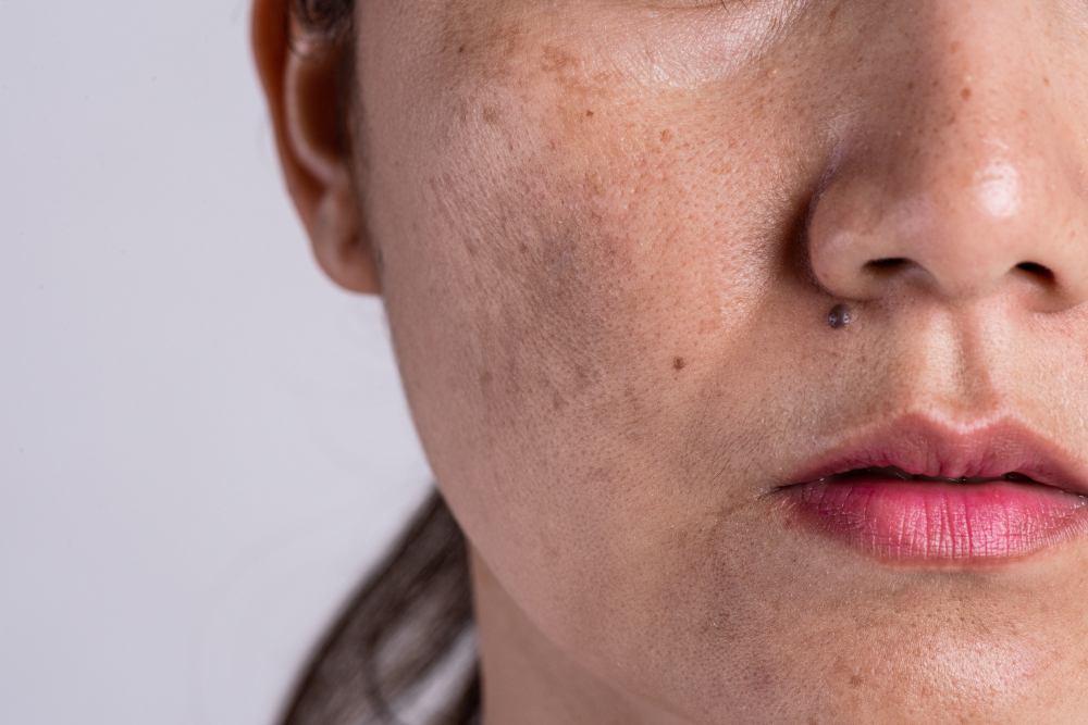 Melasma Treatment clinic in Hyderabad