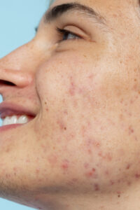 best Pimples Treatment in Hyderabad