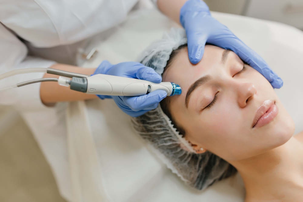 best Microneedling RF Treatment in Hyderabad