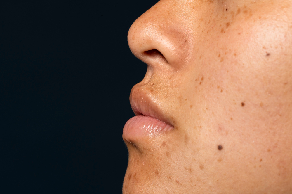 Hyperpigmentation treatment in hyderabad