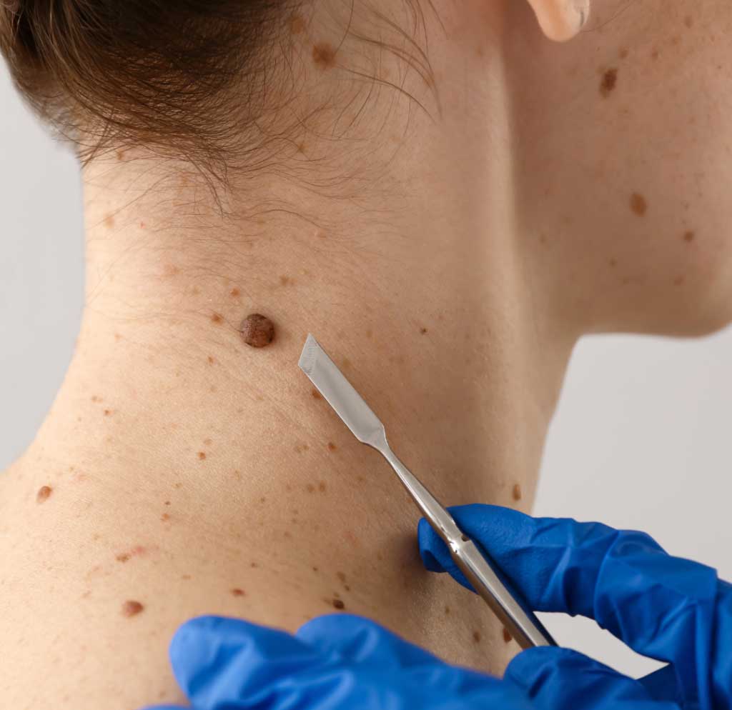 Mole Removal treatment in hyderabad