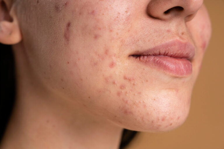 Acne Scars Treatment in Hyderabad