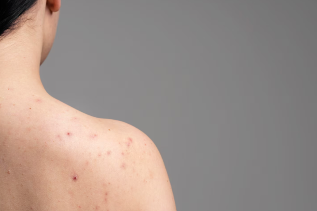 Back Acne (Bacne): Causes in Hyderabad’s Humidity and How to Treat It